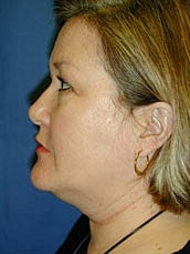 Eyelid Lift Before & After