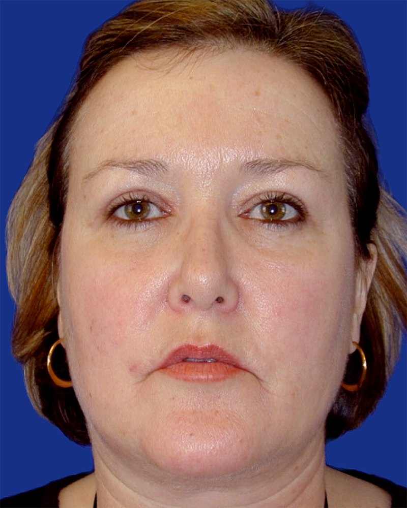 Eyelid Lift Before & After