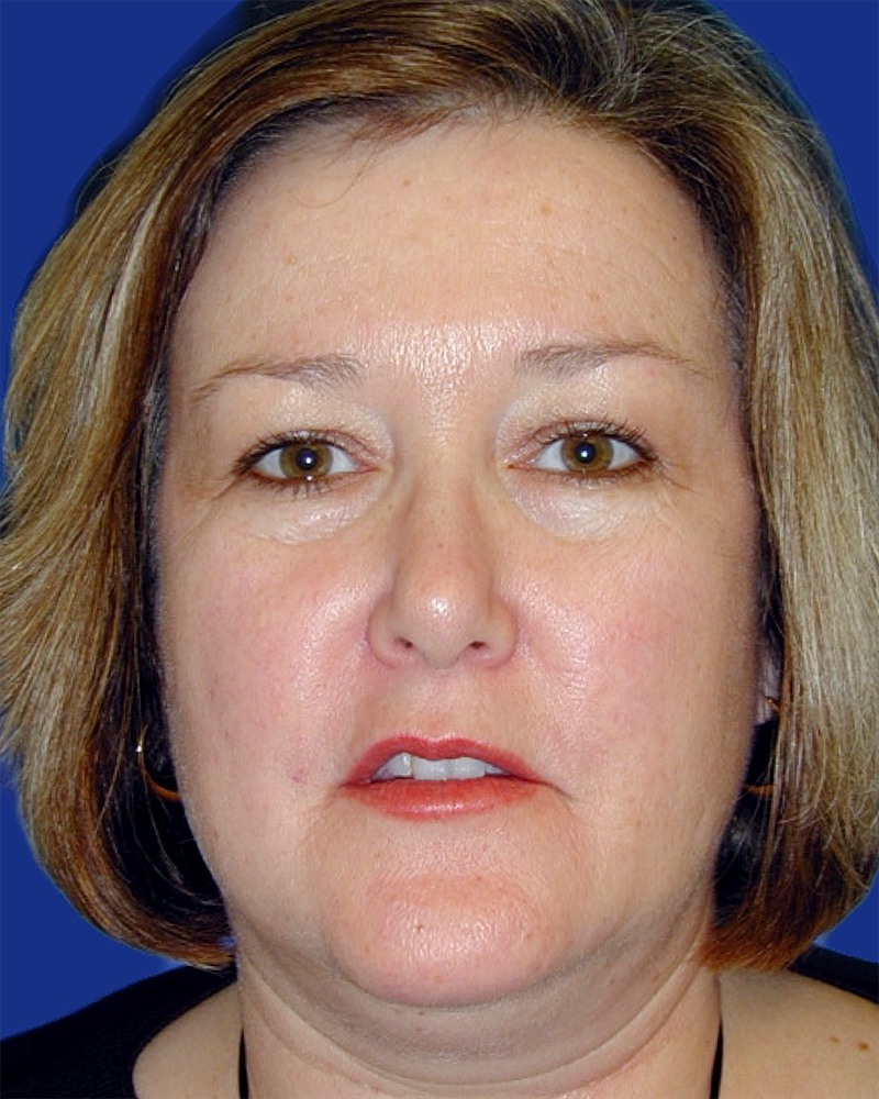 Eyelid Lift Before & After