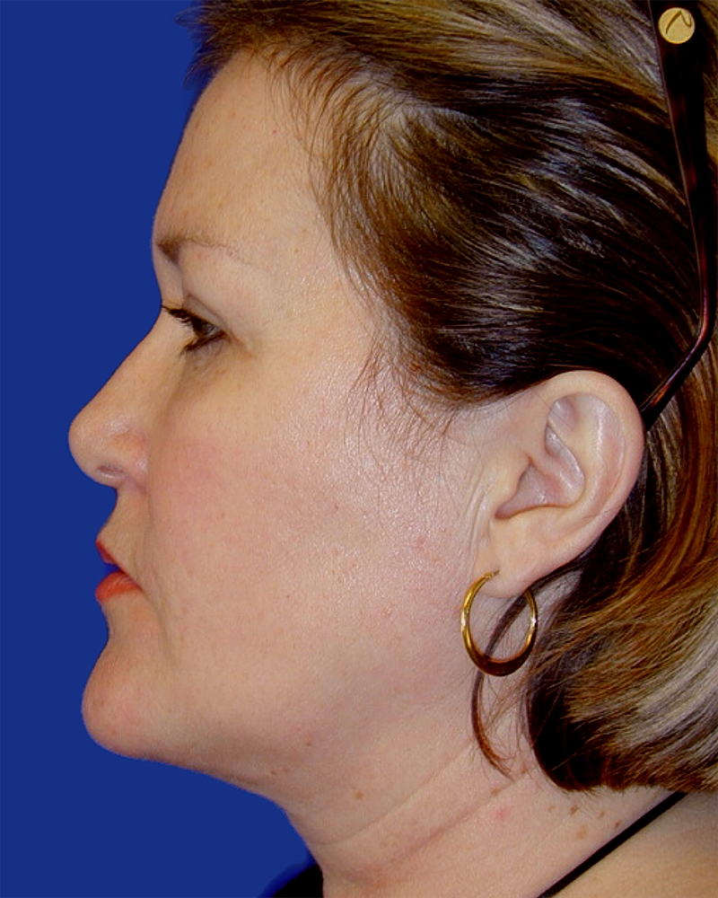 Eyelid Lift Before & After