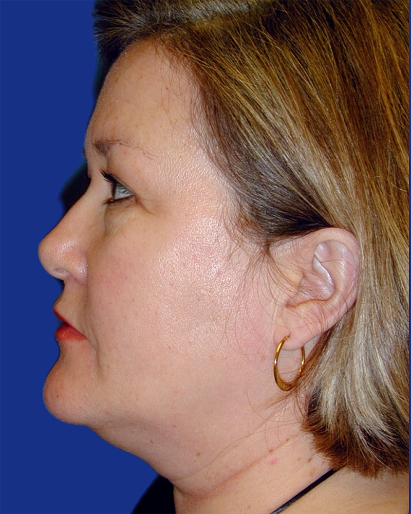 Eyelid Lift Before & After