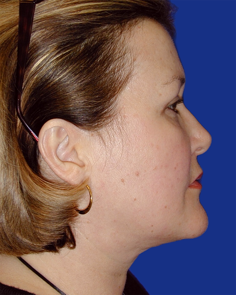 Eyelid Lift Before & After