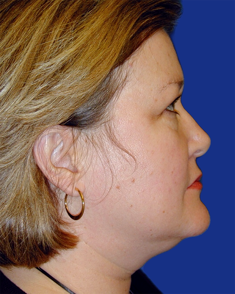 Eyelid Lift Before & After