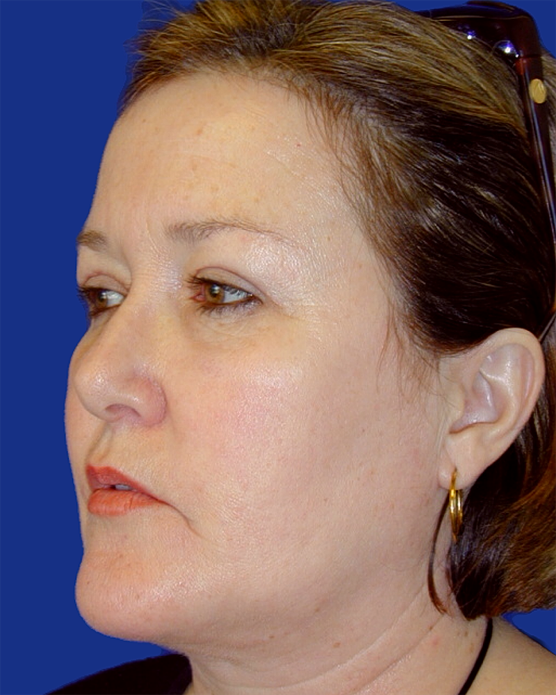 Eyelid Lift Before & After
