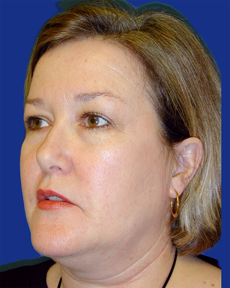 Eyelid Lift Before & After
