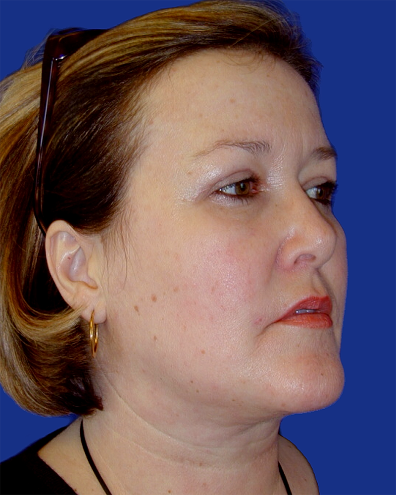 Eyelid Lift Before & After