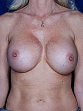 Revisional Breast Augmentation Before & After