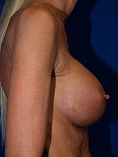 Revisional Breast Augmentation Before & After