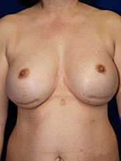 Revisional Breast Augmentation Before & After