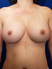 Revisional Breast Augmentation Before & After