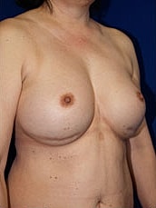 Revisional Breast Augmentation Before & After