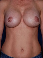 Revisional Breast Augmentation Before & After