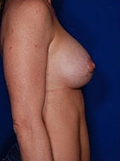 Revisional Breast Augmentation Before & After