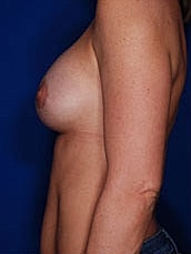 Revisional Breast Augmentation Before & After
