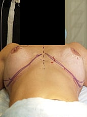 Revisional Breast Augmentation Before & After