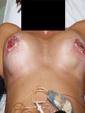 Revisional Breast Augmentation Before & After