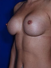 Revisional Breast Augmentation Before & After