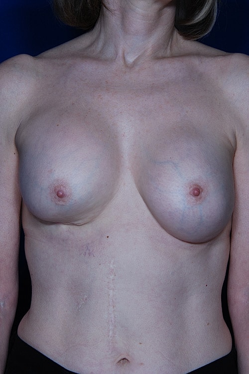 Revisional Breast Augmentation Before & After