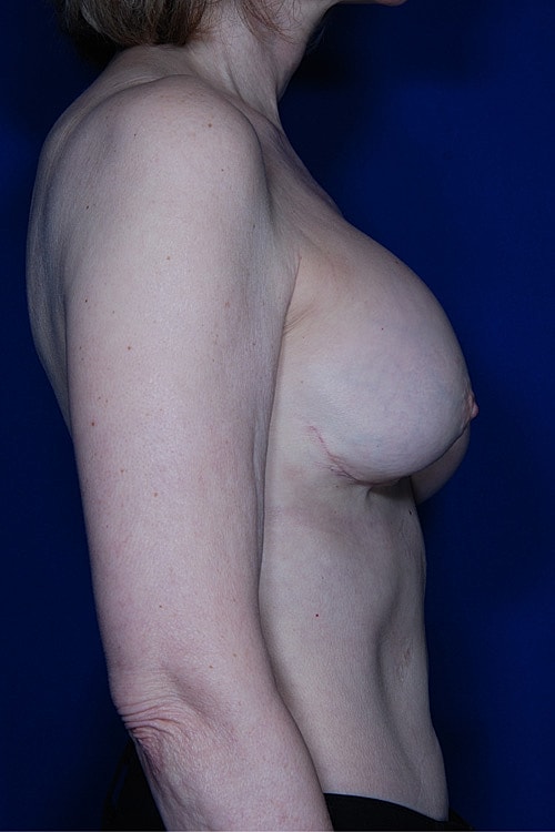 Revisional Breast Augmentation Before & After