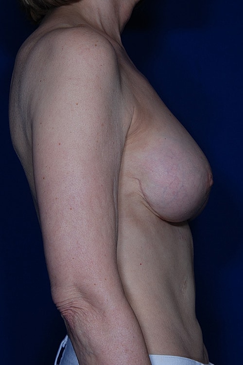 Revisional Breast Augmentation Before & After