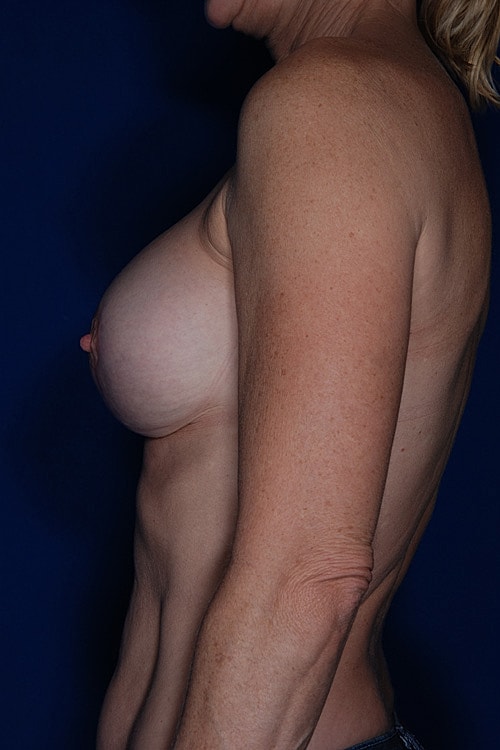 Revisional Breast Augmentation Before & After