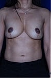 Revisional Breast Augmentation Before & After