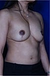 Revisional Breast Augmentation Before & After