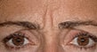 Botox Before & After