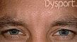 Botox Before & After