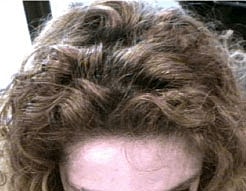 Hair Re Growth Before & After