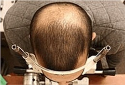 Hair Re Growth Before & After