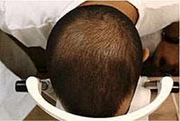 Hair Re Growth Before & After