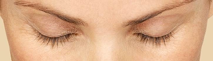 Latisse Before & After