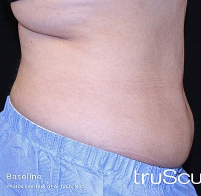 Trusculpt 3d Before & After