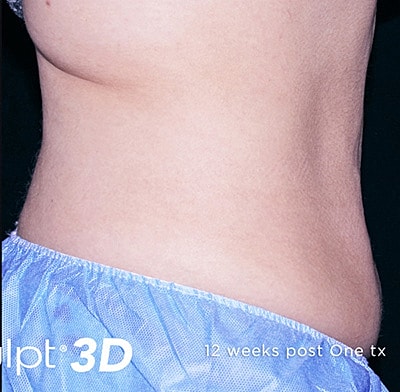 Trusculpt 3d Before & After