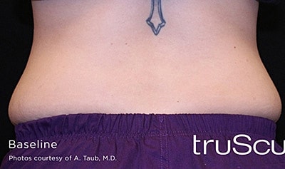 Trusculpt 3d Before & After