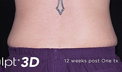 Trusculpt 3d Before & After