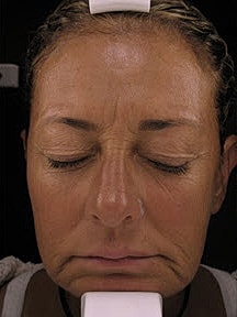Skin Resurfacing Before & After