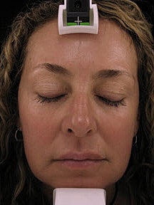Skin Resurfacing Before & After