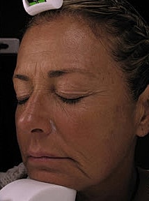 Skin Resurfacing Before & After