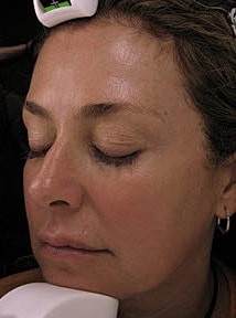Skin Resurfacing Before & After