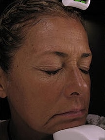 Skin Resurfacing Before & After