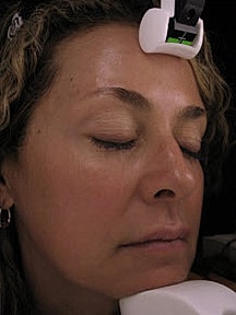 Skin Resurfacing Before & After