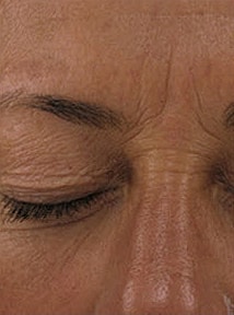 Skin Resurfacing Before & After