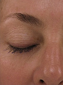 Skin Resurfacing Before & After
