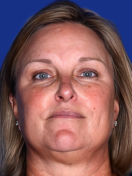 Skin Resurfacing Before & After