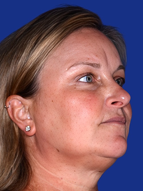 Skin Resurfacing Before & After