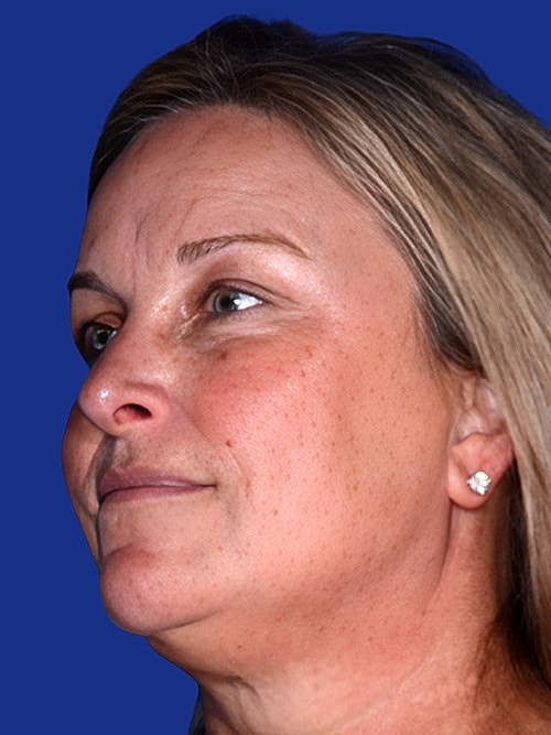 Skin Resurfacing Before & After