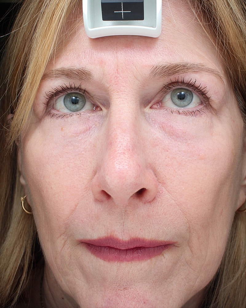 Skin Resurfacing Before & After