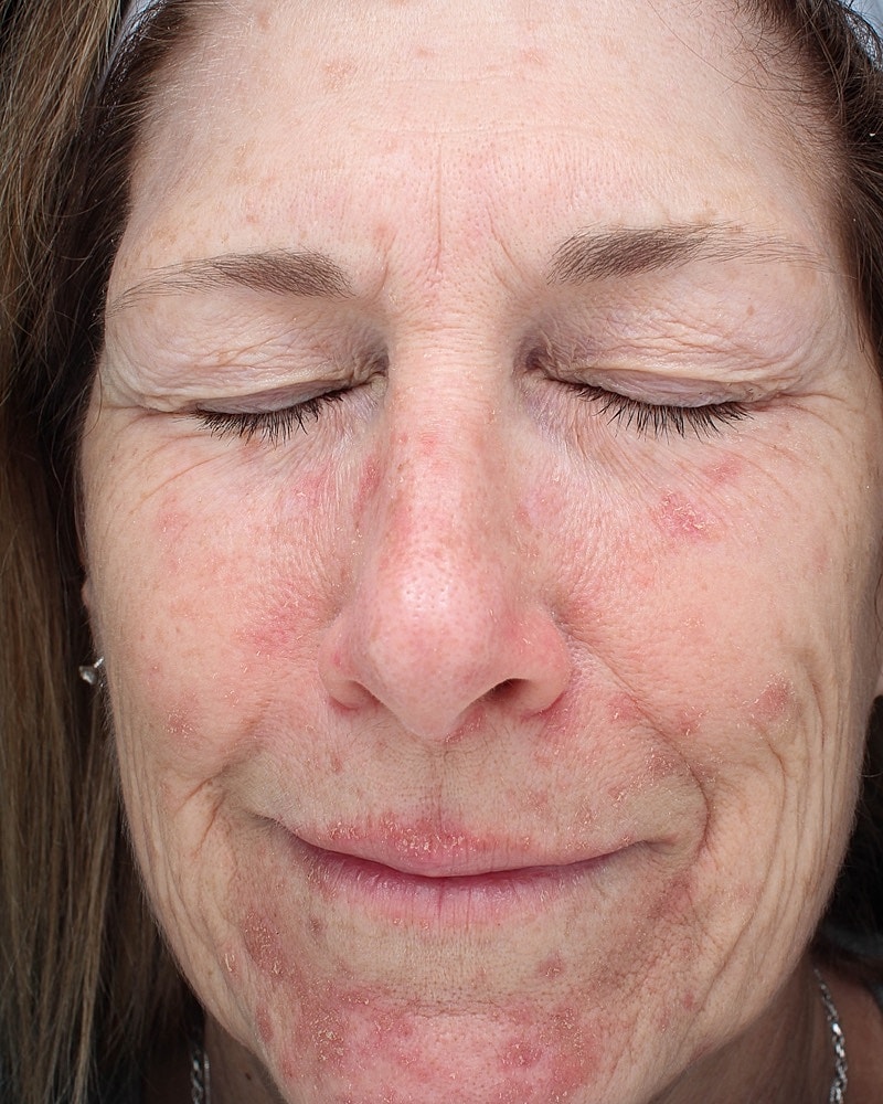 Skin Resurfacing Before & After